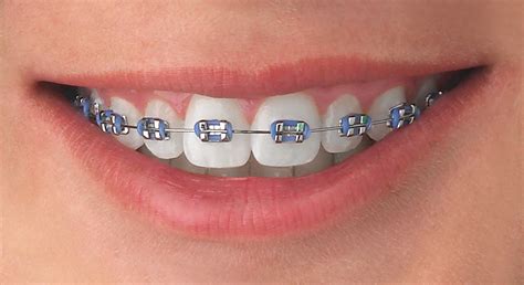 sonrisa con brackets ceramicos y metalico|Tipos De Brackets En Odontología: Como Funcionan Cuál Elegir .